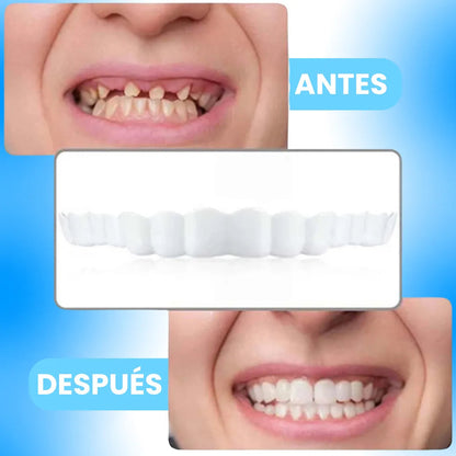 Carillas Dentales SnapOnSmile™ | Compra 1 y Llevate 2